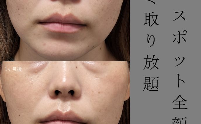 ピコスポット全顔　シミ取り放題　症例写真