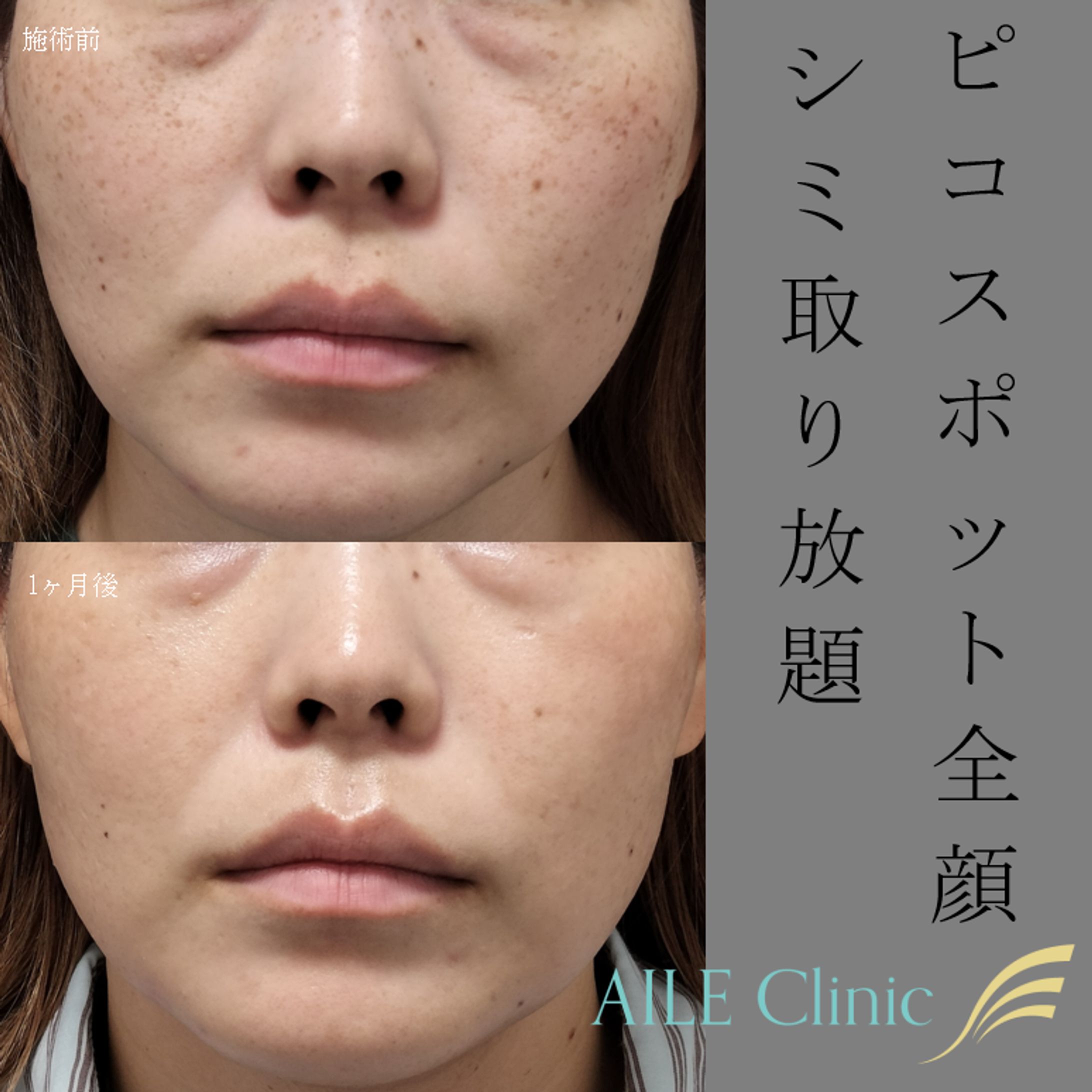 ピコスポット全顔　シミ取り放題　症例写真-1