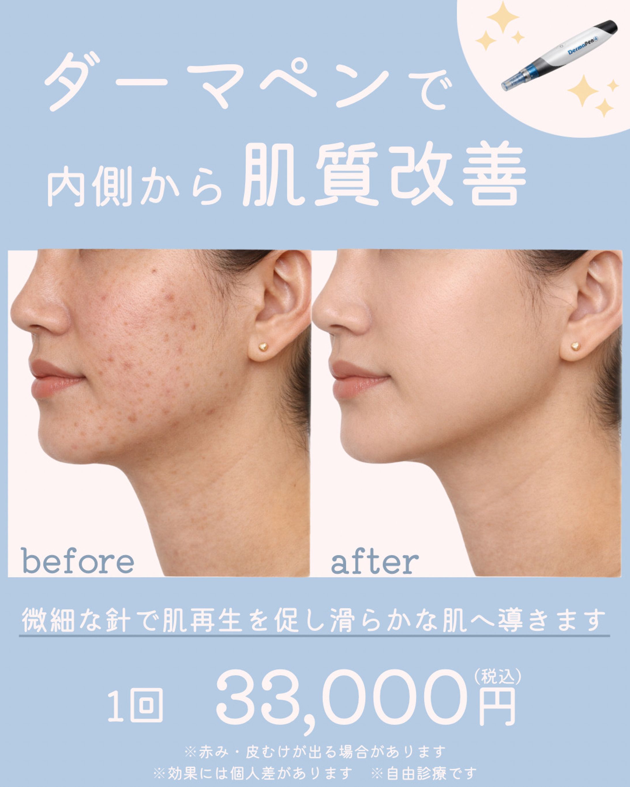 ダーマペン 投稿画像-1