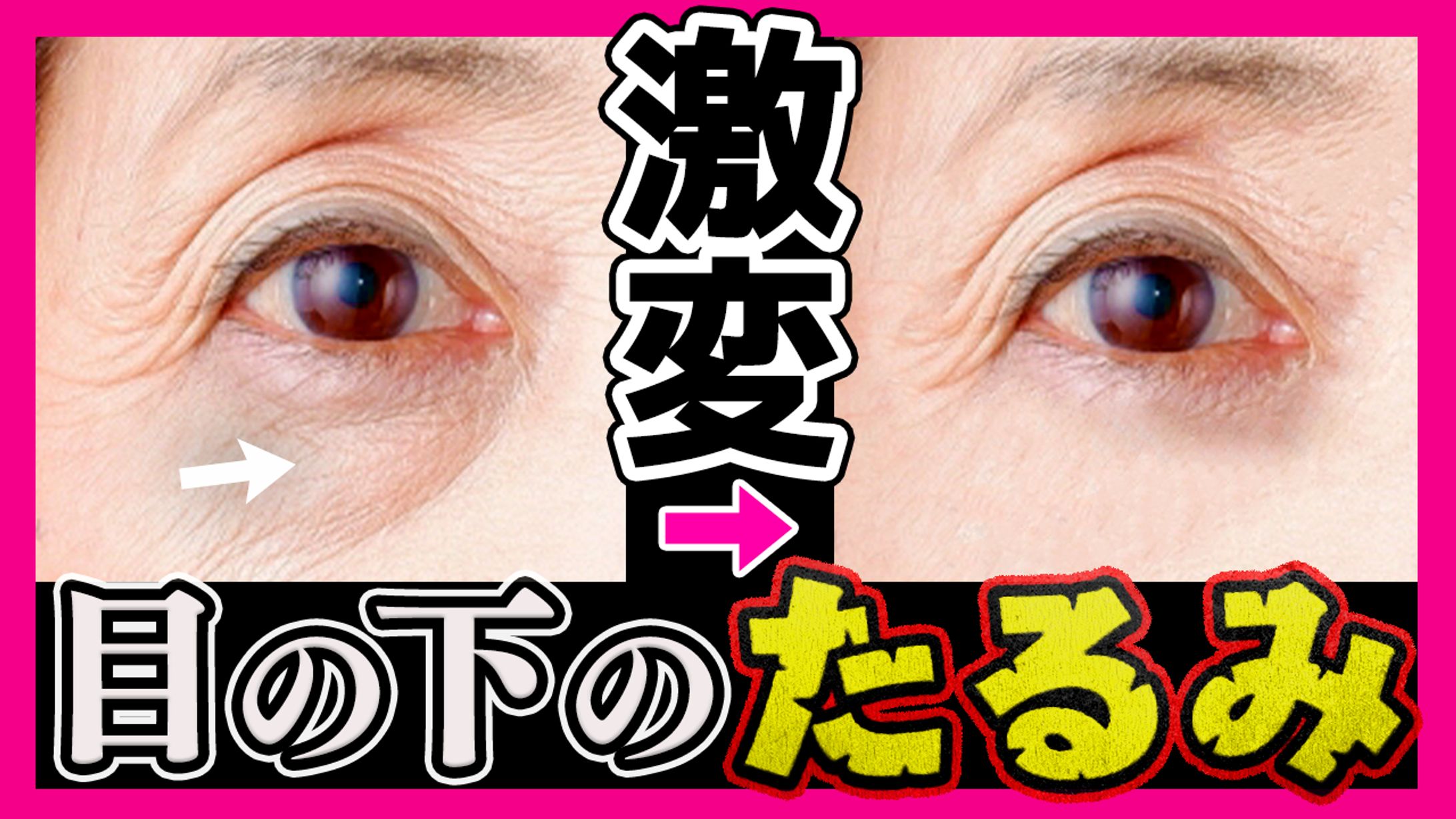 美容系サムネイル「激変 目の下のたるみ」-1