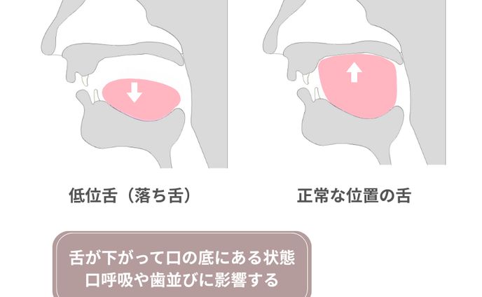 低位舌
