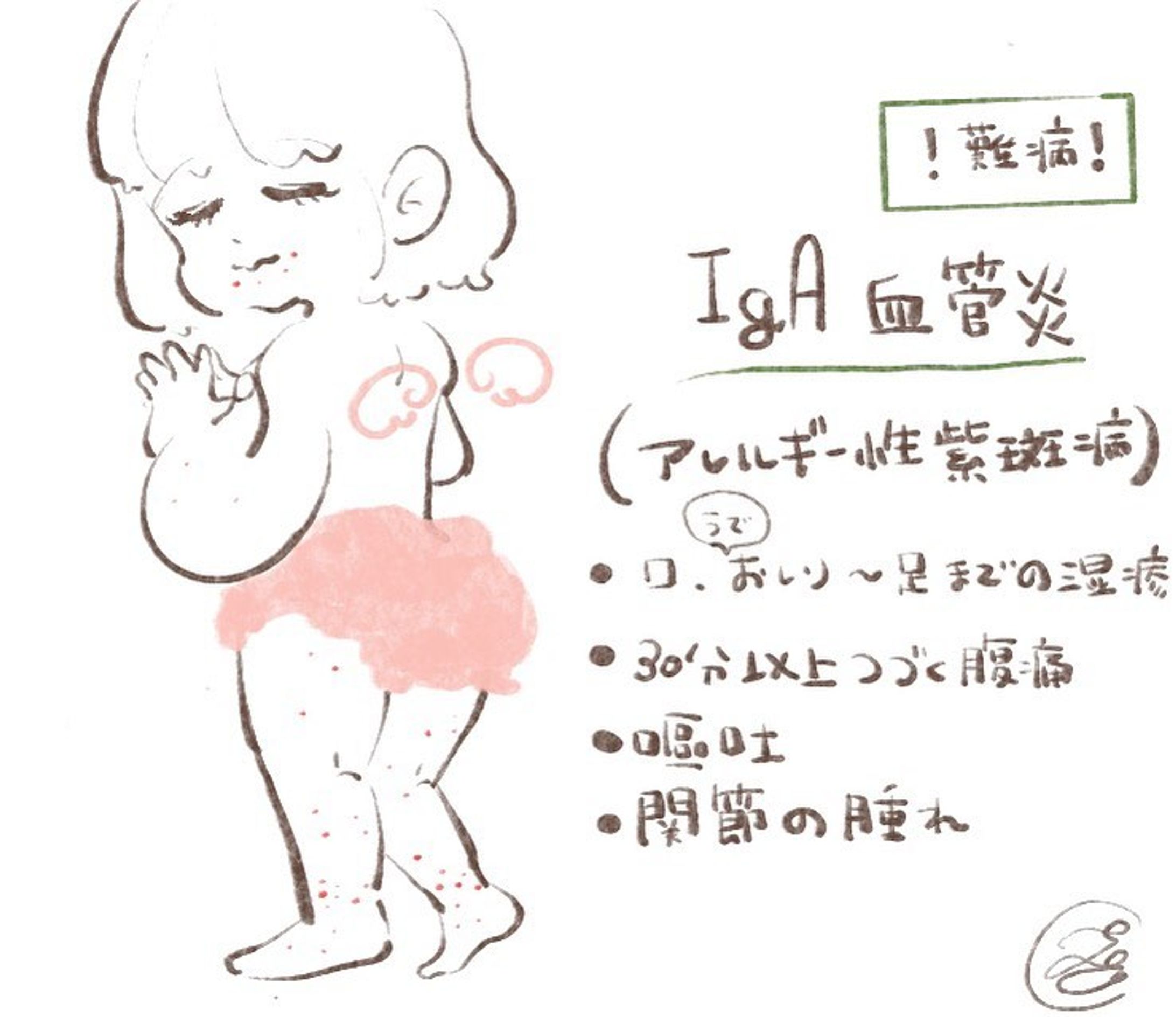 ----------♡----------

‪𝐃𝐚𝐲‬ 22 IgA血管炎

お久しぶりです！
今日から100日チャレンジ再開します🙌🏻

数日は次女が掛かった病の詳細をイラストで説明、記録していきたいと思います。

アレルギー性紫斑病は小児の病気に良くある病気らしいです。
ですが、難病指定されていたりと娘自身も発見に1週間ほど時間がかかりました。
何度も何度も病院へ足を運びましたが、紫斑病ではないと言われ適切な治療を受ける事が出来ず、結果的に入院する事になってしまいました。
私と娘がした経験を発信し
1人でも多くの方に
この病気にいち早く気づき
適切な治療を受けて、子供が苦しまずに済む様に
ひとつの判断材料になればいいな思います。

【アレルギー性紫斑病】と検索すれぱ
すぐに症状が出でくると思いますが
それとはまた少し異なった症状で娘は発症してしまい、判断に遅れました。

詳細は追って投稿していきたいと思います。

#アレルギー性紫斑病  #iga血管炎  #入院  #2歳  #3歳  #病気  #小児科  #皮膚科 
 #100日チャレンジ  #育児日記  #1日1絵  #かわいい  #ゆるいイラスト #女の子ママ  #女の子  #日常#illustrations  #illustrate #cute  #girl  #일러스트 #데일리  #귀여워 #패션  #그림스타그램-1