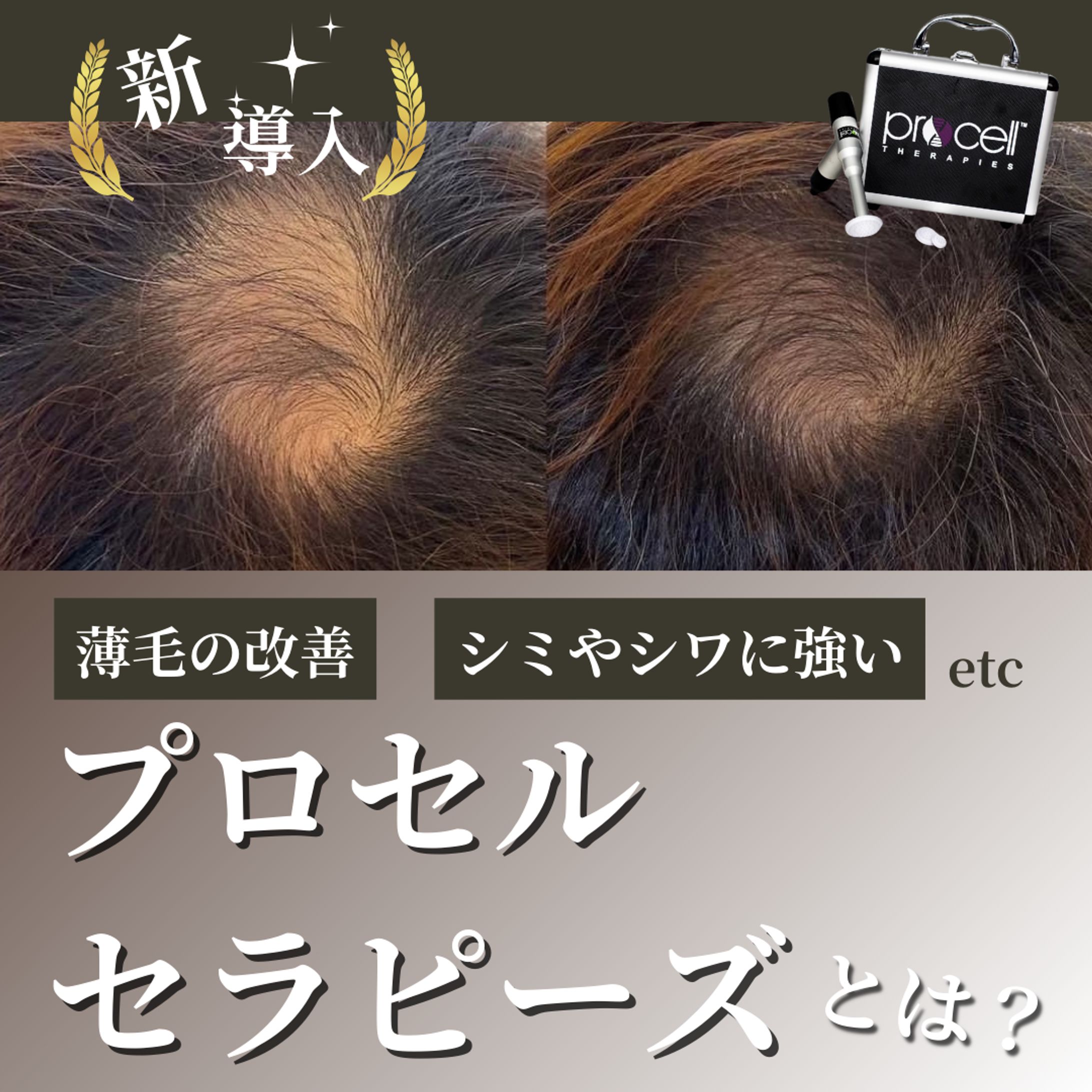 【フィード投稿事例】メンズAGA治療-1