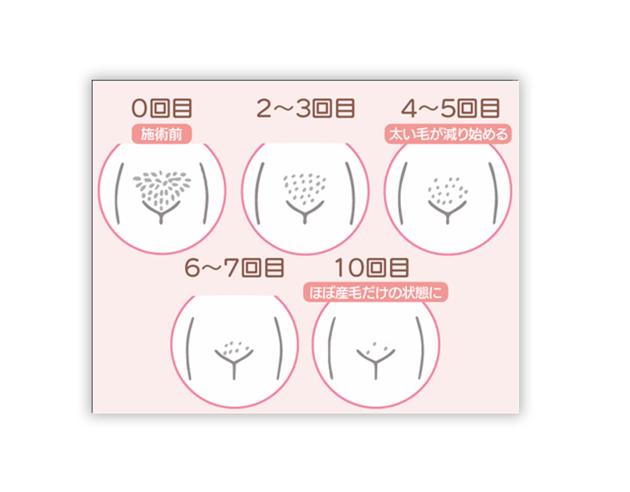脱毛経過イラスト(コンペ採用)-1
