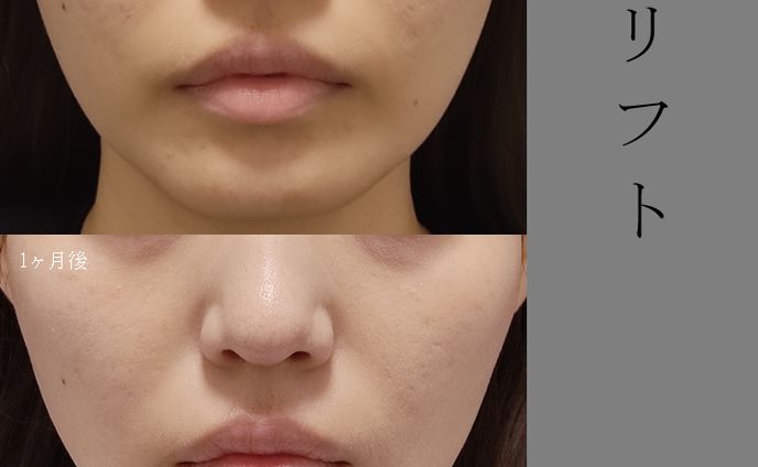 糸リフト　1ヶ月後　症例写真