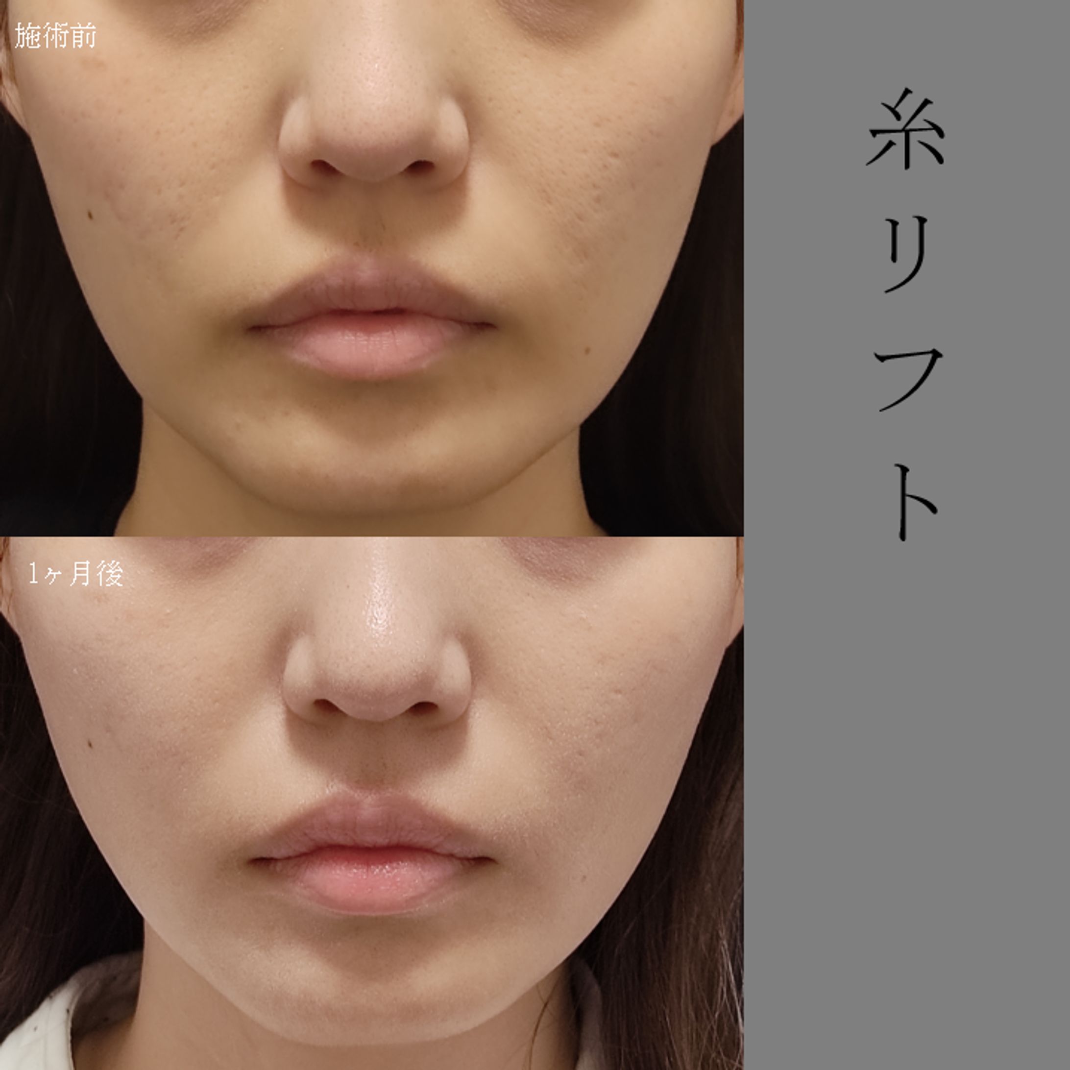 糸リフト　1ヶ月後　症例写真-1