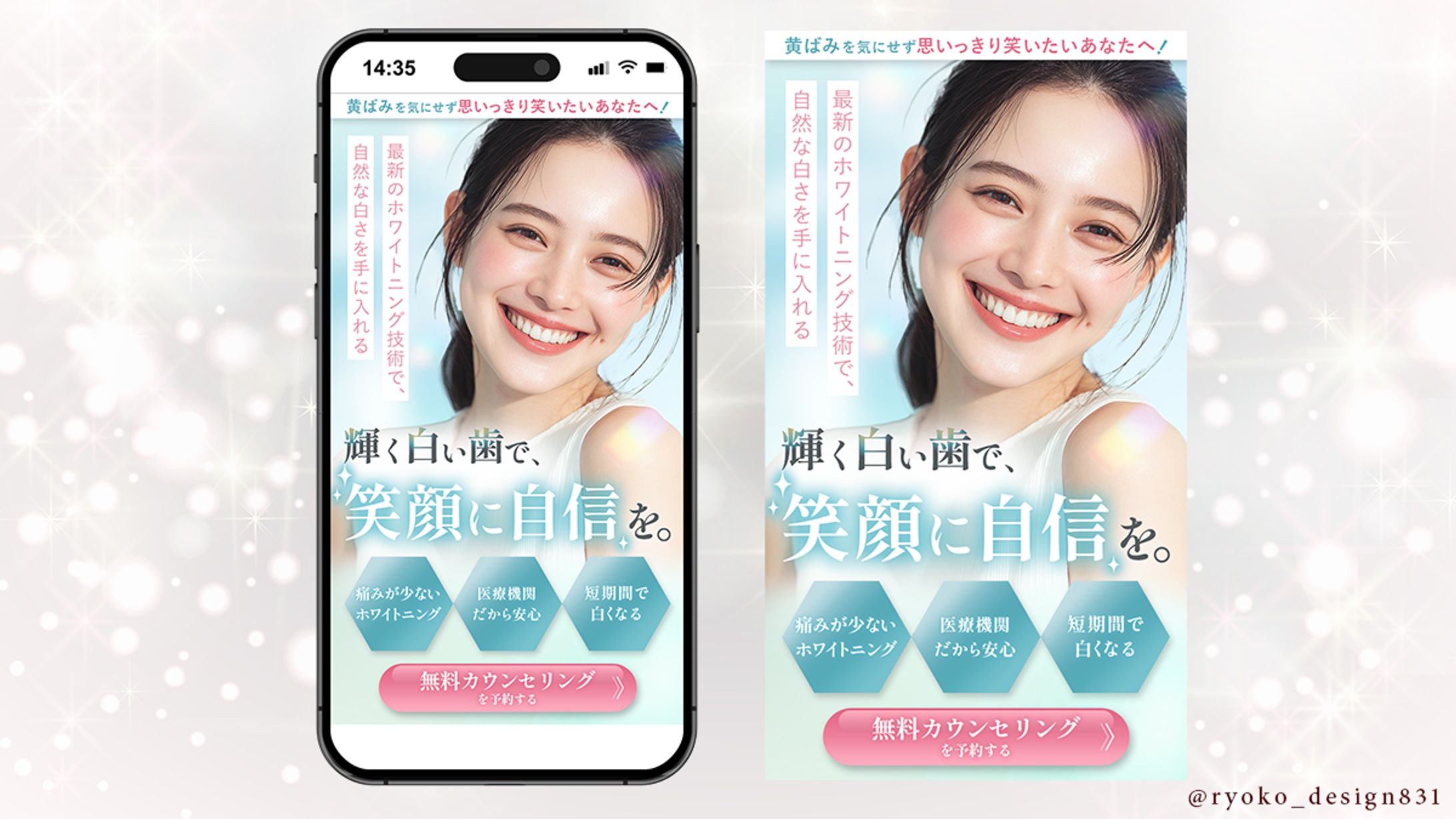 【LPFV】歯医者のホワイトニング-1