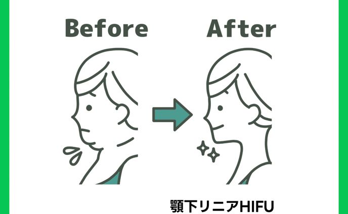 LINE広告バナー