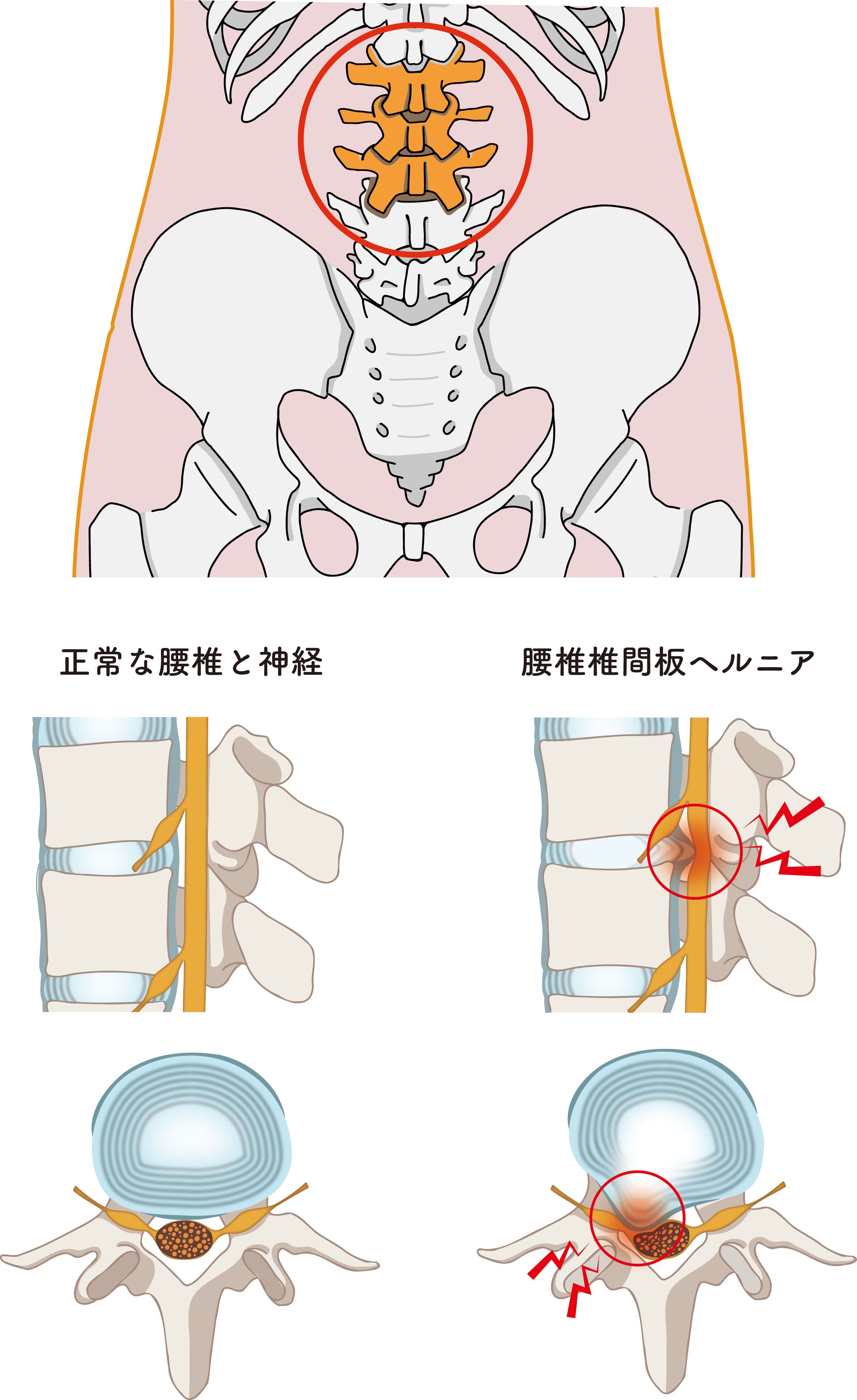 腰椎ヘルニアの説明イラスト-1