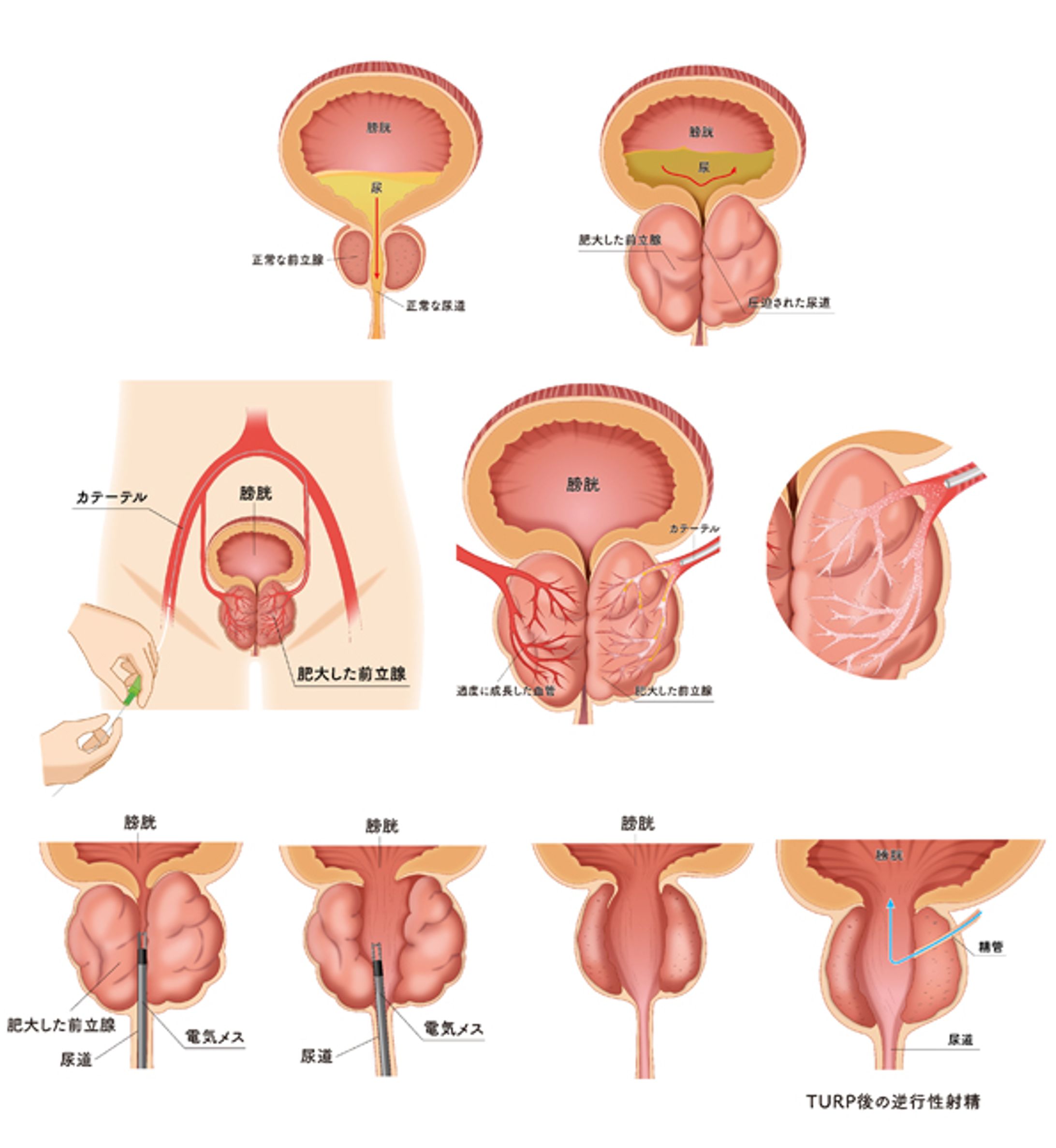 前立腺肥大説明とカテーテル治療説明のHP用イラスト-1