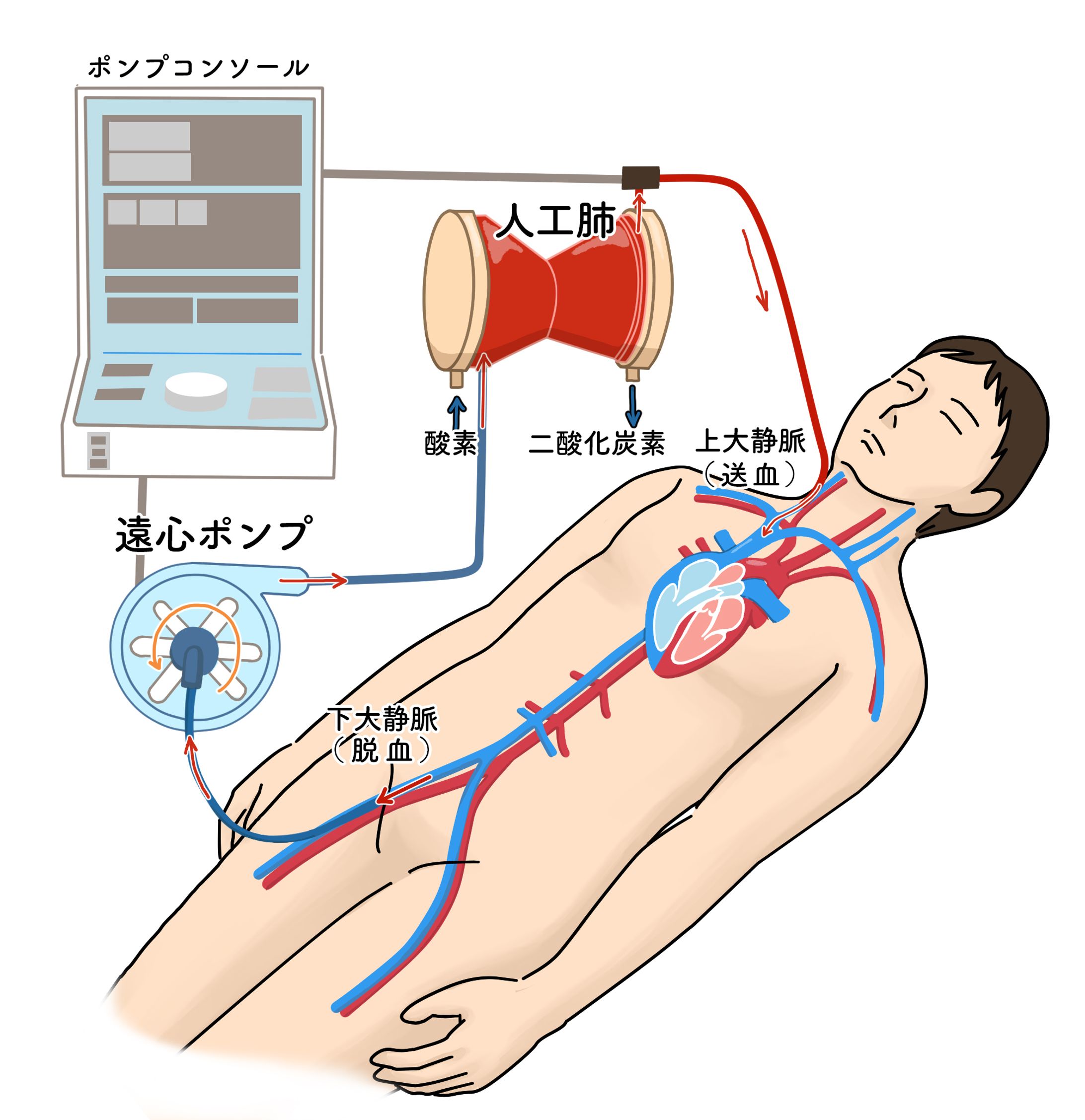 ECMO（エクモ）の構造がわかるイラスト-1