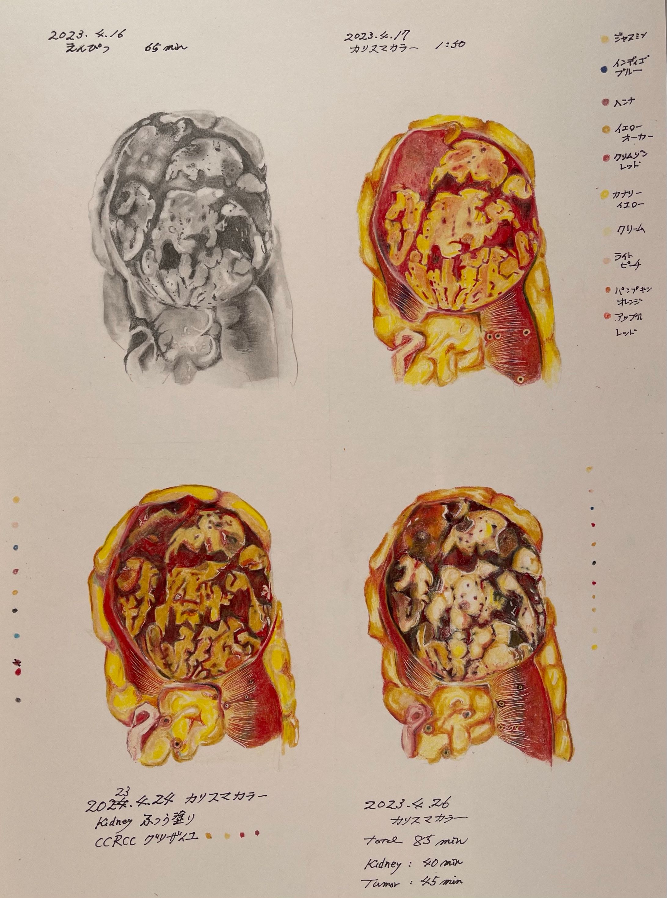 KIDNEYS Clear cell renal cell carcinoma-1