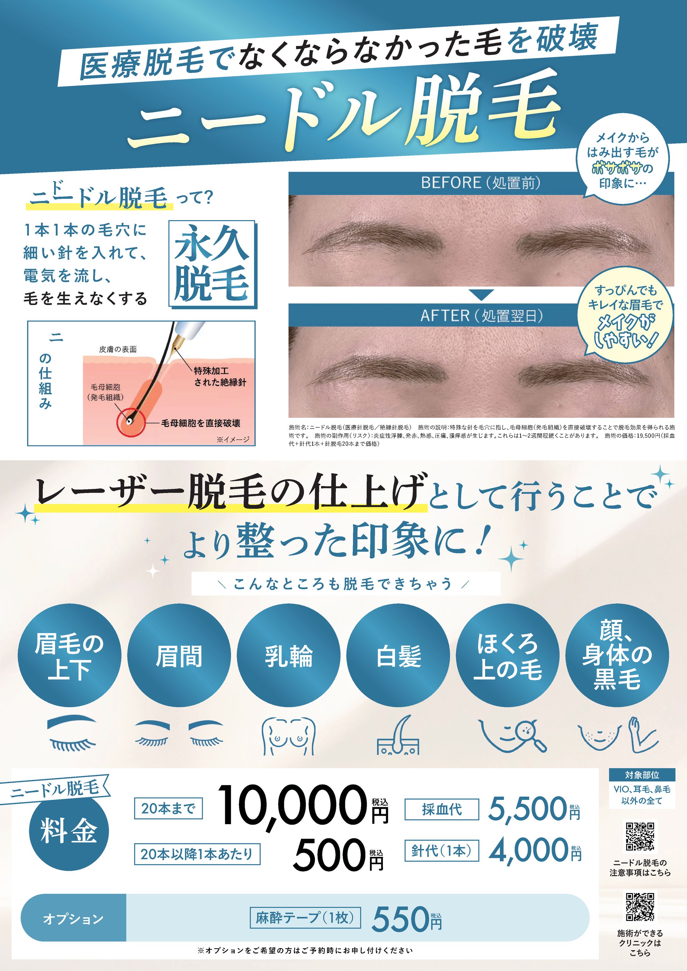 【POP】ニードル脱毛-1