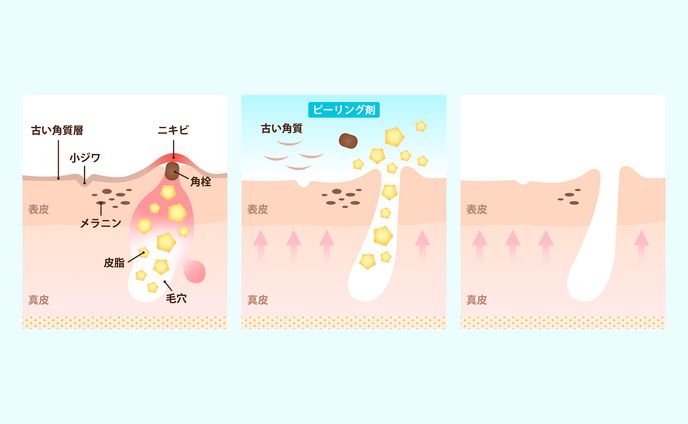 oneUPclinic - サリチル酸ピーリングアートワーク