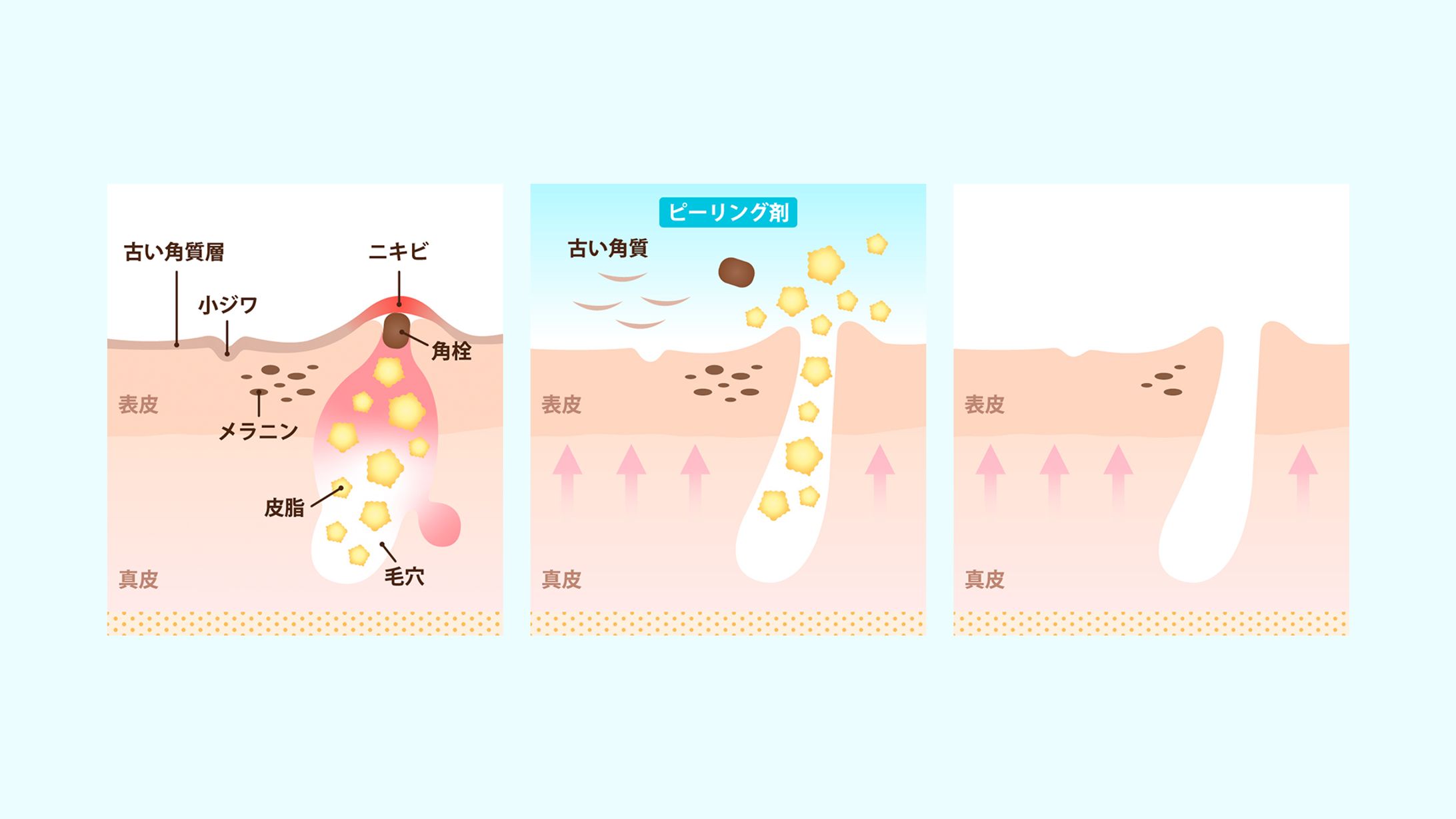 oneUPclinic - サリチル酸ピーリングアートワーク-1