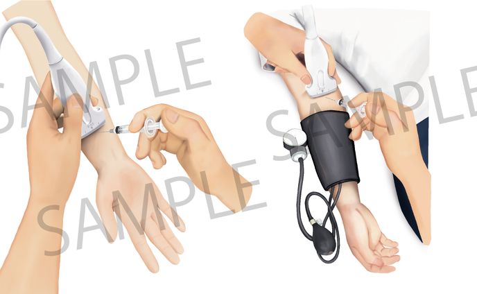 クリニック施術説明用イラスト