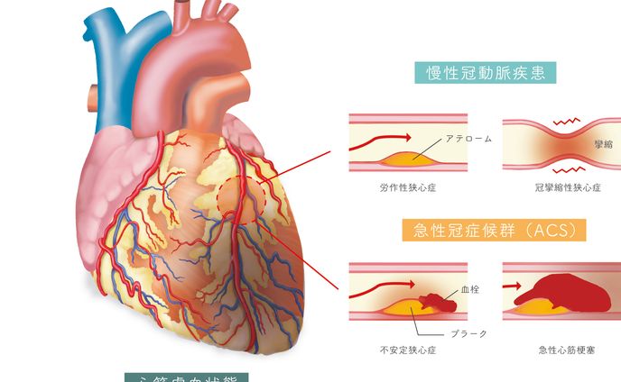 心筋梗塞の種類とイメージイラスト