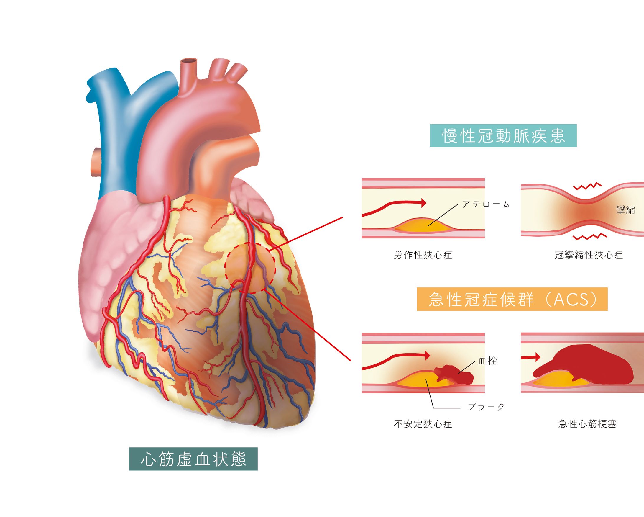 心筋梗塞の種類とイメージイラスト-1