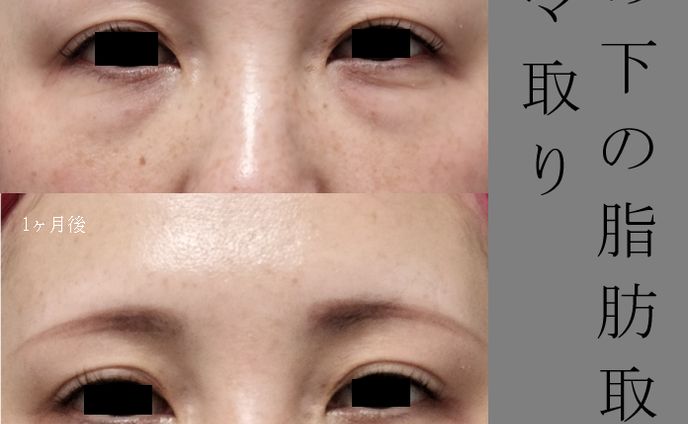 目の下の脂肪取り　1ヶ月後　症例写真