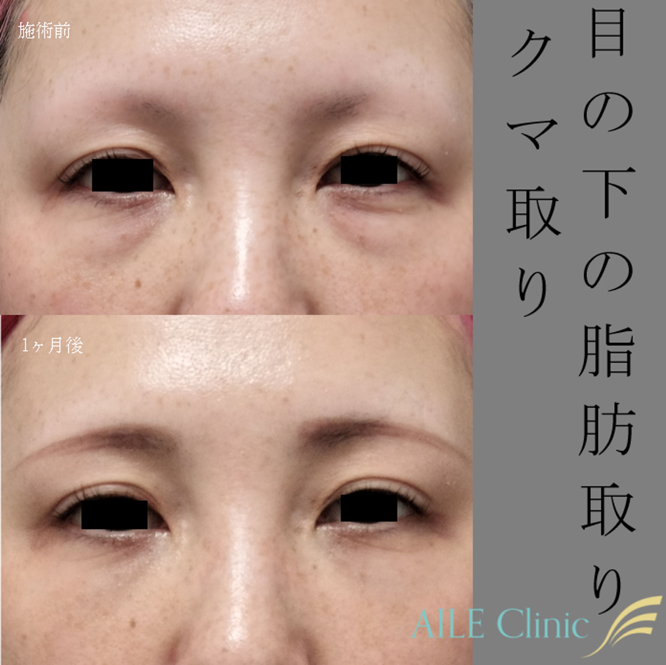 目の下の脂肪取り　1ヶ月後　症例写真-1