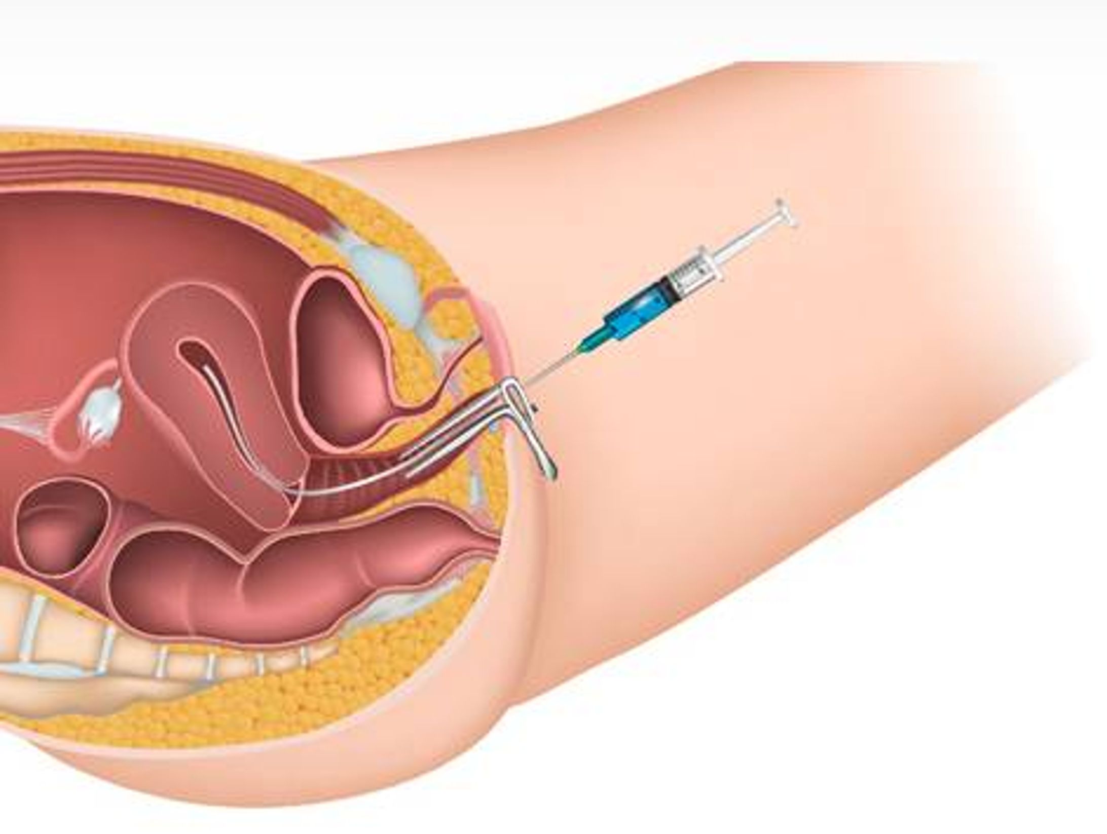 人工授精産業、分析、動向、成長概況 — 2025年〜2037年予測-1
