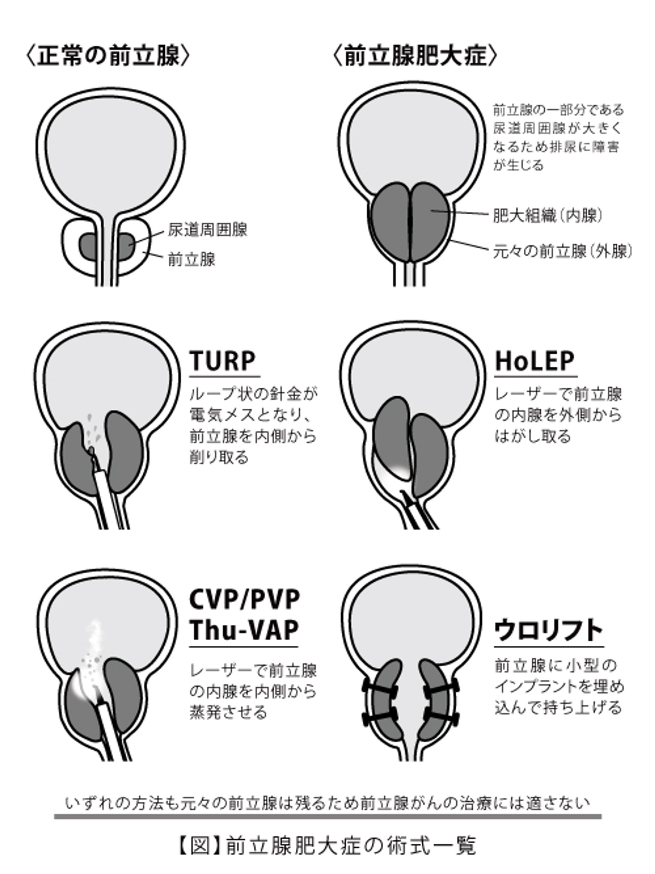 前立腺がんに関する書籍挿絵-1