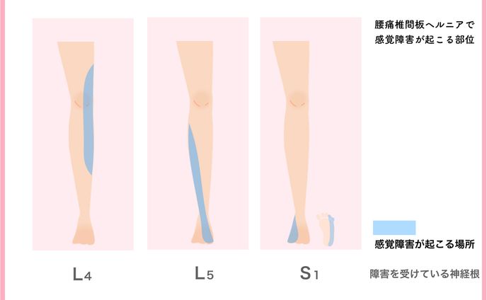 説明用画像　感覚障害.001