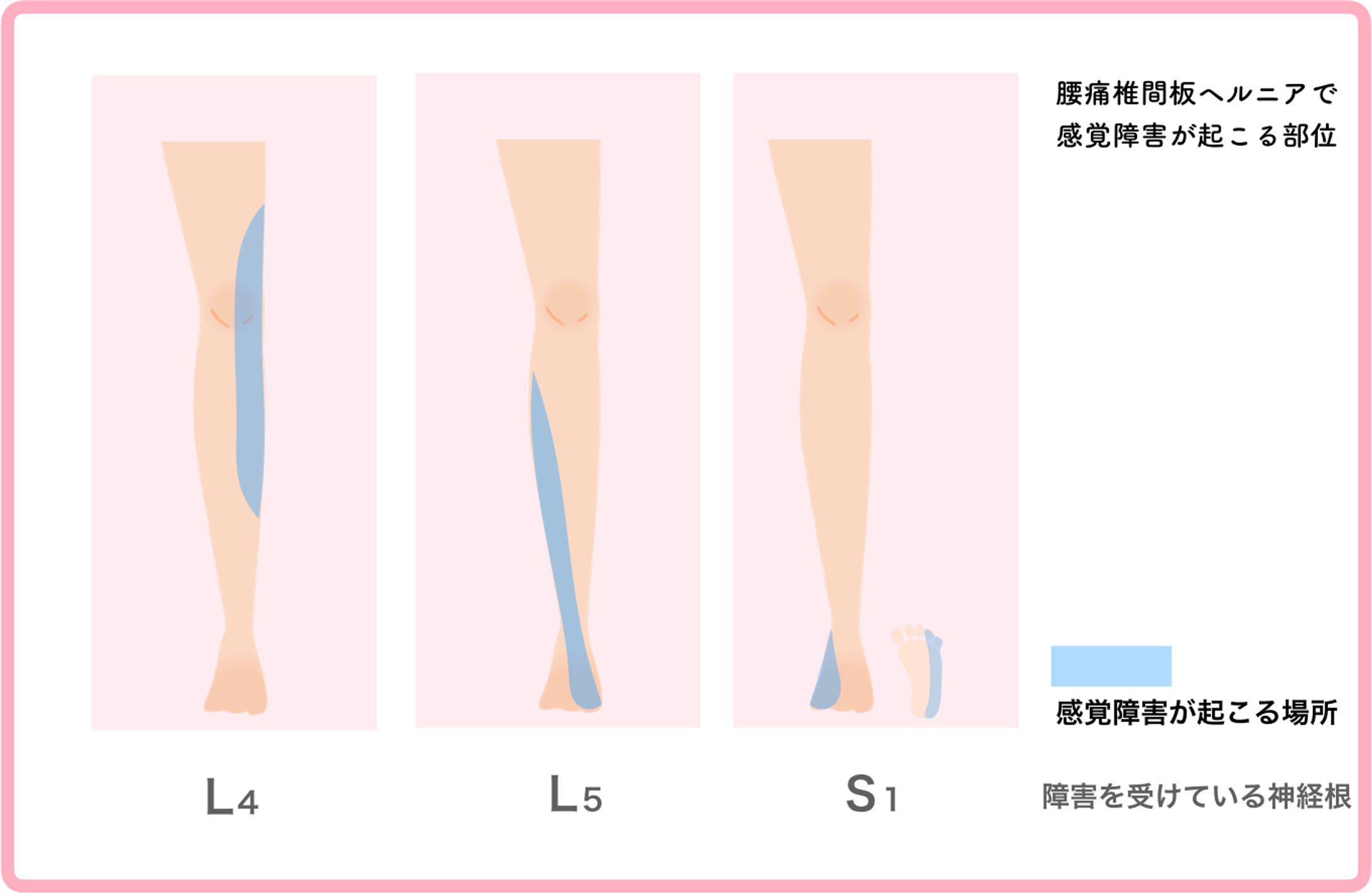 説明用画像　感覚障害.001-1