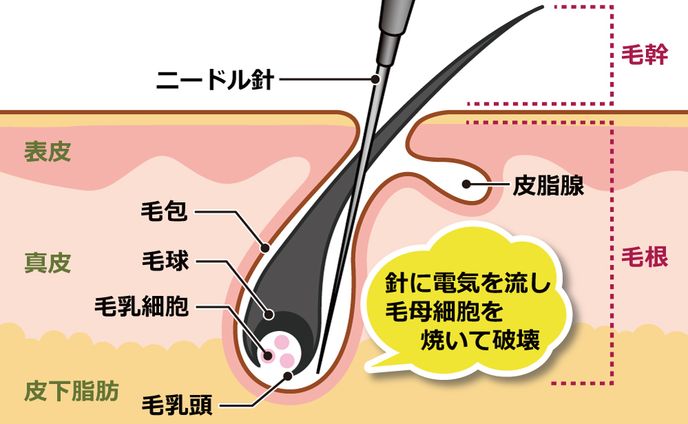 ニードル脱毛の仕組み