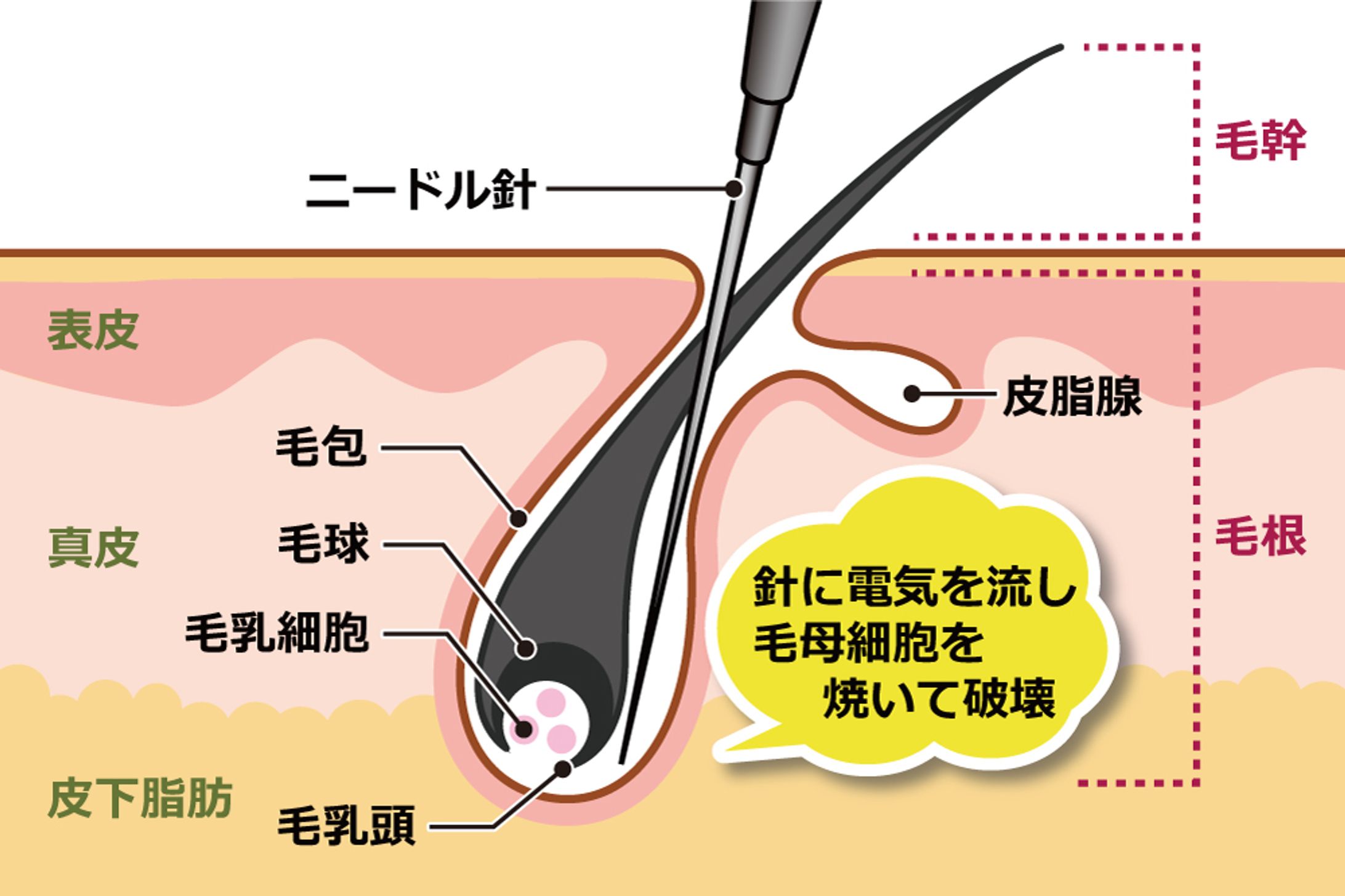ニードル脱毛の仕組み-1